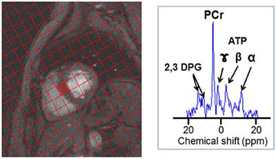 Cardiac Energetics Before, During, and After Anthracycline-Based Chemotherapy in Breast Cancer Patients Using 31P Magnetic Resonance Spectroscopy: A Pilot Study